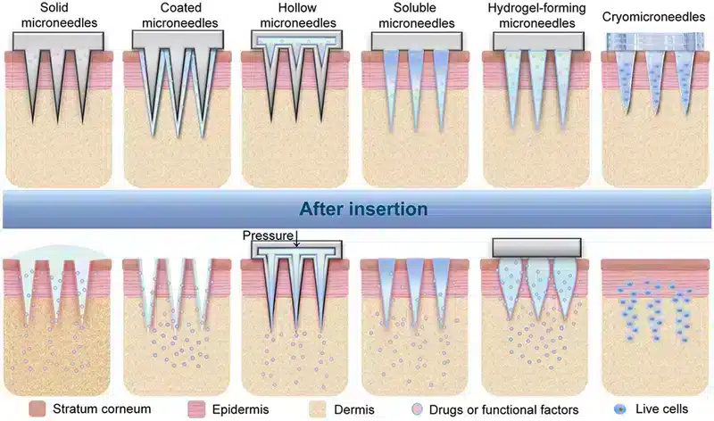 Types of microneedles drug delivery - Fluigent Types of microneedles drug delivery